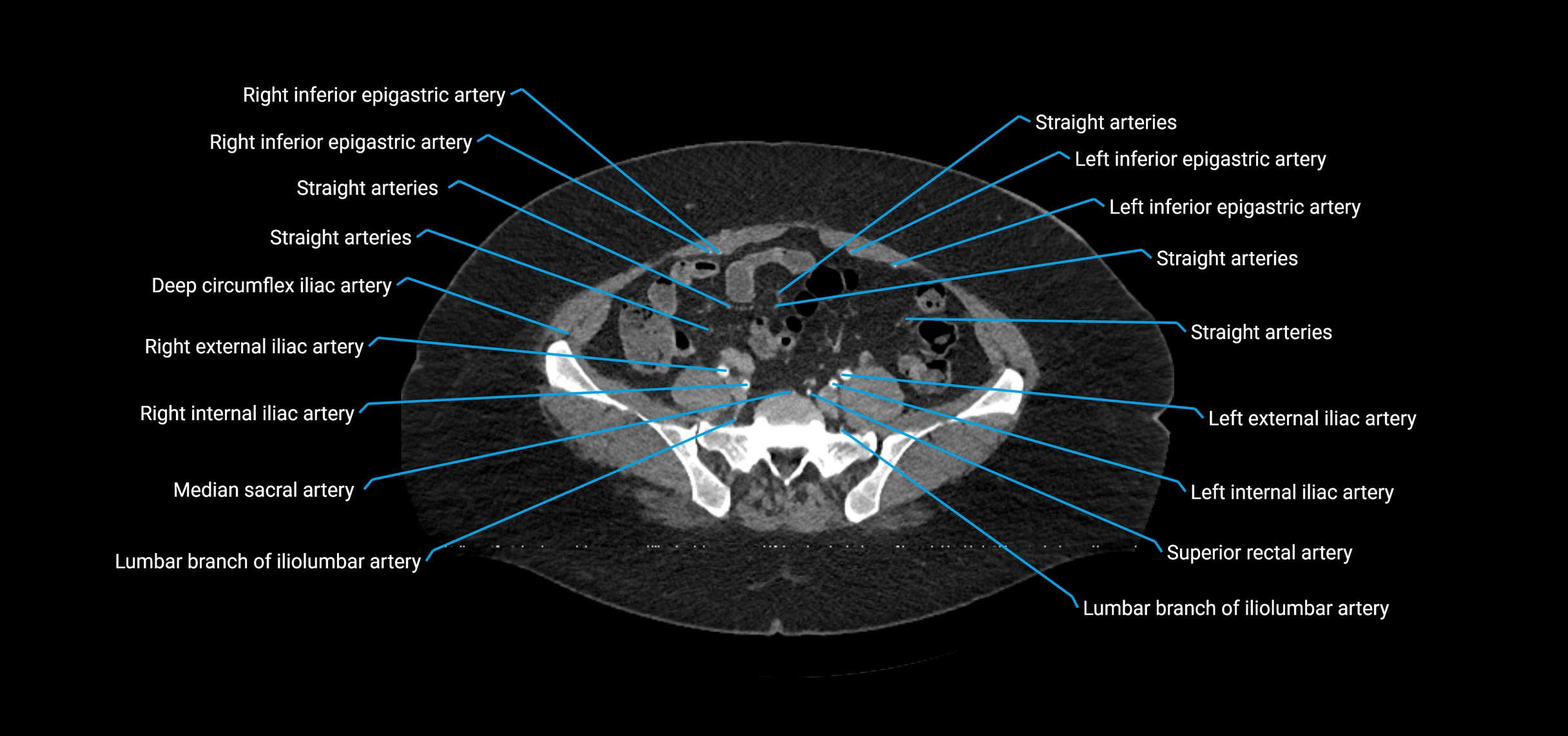 CTA abdomen axial cross sectional anatomy labelled image_179 (2).webp